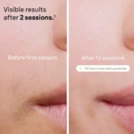 لیزر بدن براون مدل Silk-expert Pro 5 PL5146 - Image 5